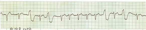Atrial Fibrillation with ventricular ectopics