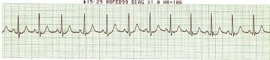 Sinus Tachycardia