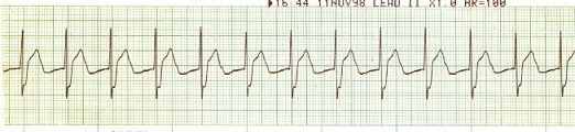 Sinus Rhythm - MI