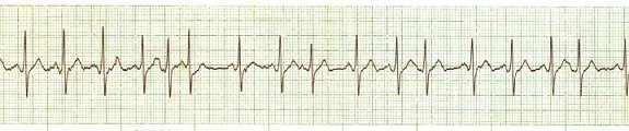 multifocal atrial tachycardia
