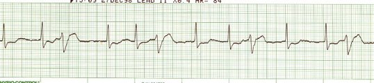 A Fib with ventricular trigeminy