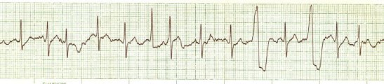 A Fib with ectopy