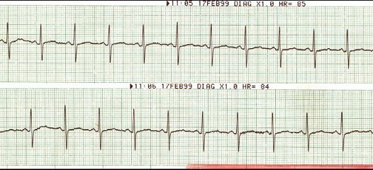 Sinus Rhythm