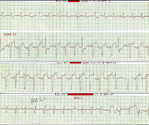 Sinus tach/AMI