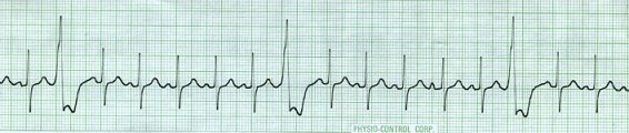 sinus with PVCs