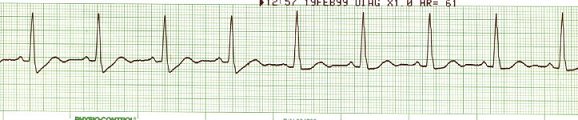 Sinus Rhythm