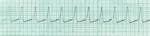 Sinus Rhythm