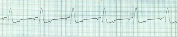 Sinus with Mobitz II