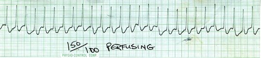 Atrial Tachycardia