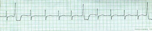 PVCs