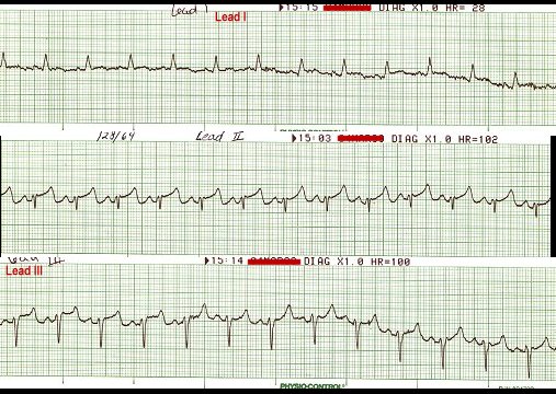 Sinus Tach