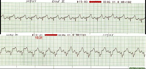 Sinus Tach