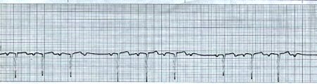 Junctional Rhythm with Wenkebach