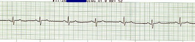 Sinus Bradycardia