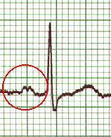 notched P-wave