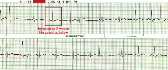 sinus rhythm
