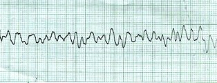 Ventricular Fibrillation