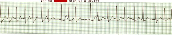 Rapid Atrial Fibrillation