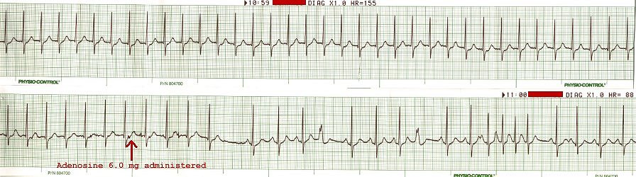 SVT - Adenosine