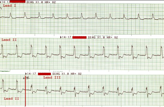 LBBB/LAD