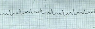 Sinus with BBB