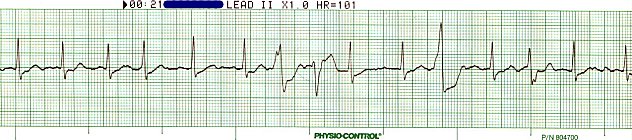 A. Fib with Multiformed Ventricular Ectopics