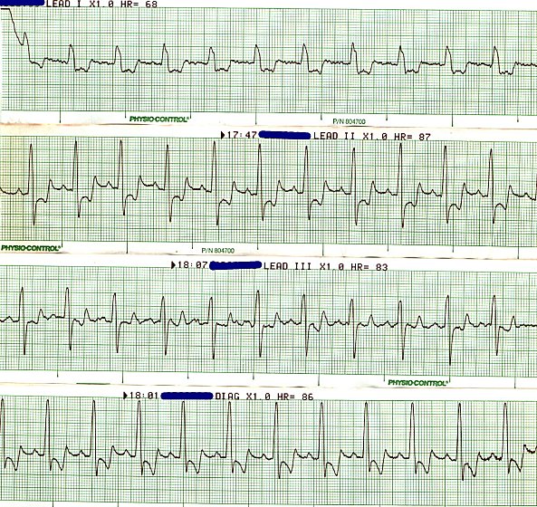 Sinus rhythm - recent MI