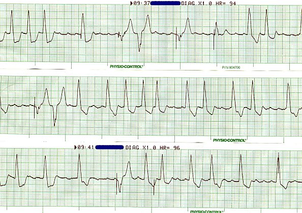 Sinus tach with demand ventricular pacemaker