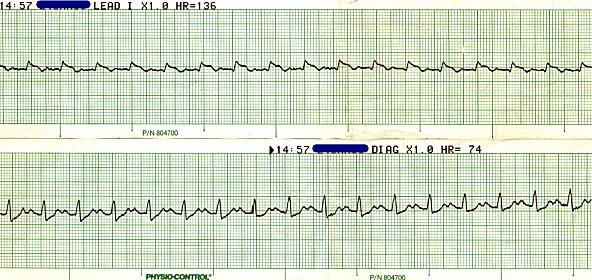 sinus tach -1st degree AV block