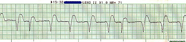 ST elevation