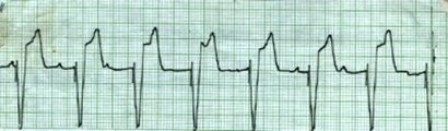 Demand Pacemaker