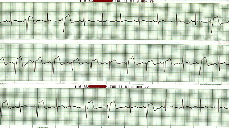 AMI - Post TPA