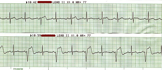 AMI - post TPA