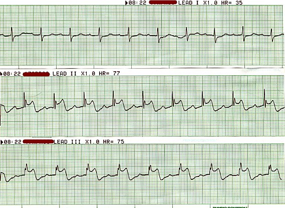 Acute Inferior MI