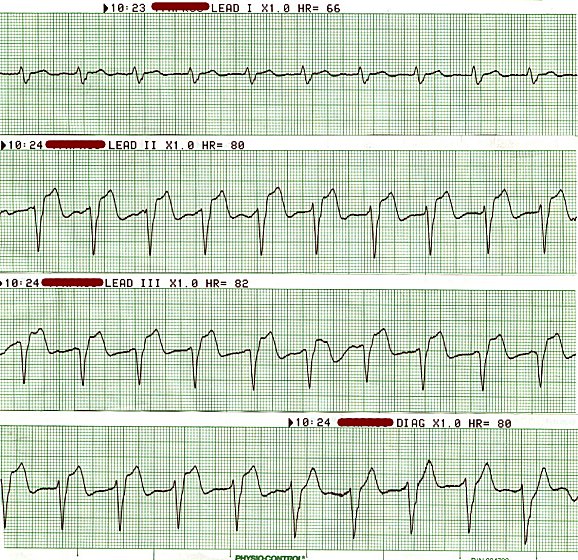 AMI - Post TPA