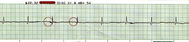 Sinus Bradycardia