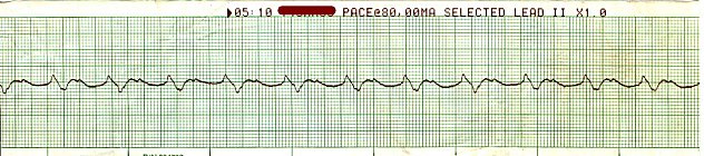 Accelerated Idioventricular