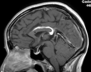 lipoma_corp_mri_sag.jpg (17017 bytes)