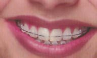 clear braces