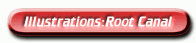 click for details on Root canal treatment