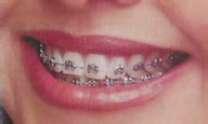 silver braces