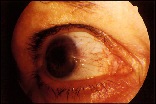 pterigium