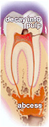 Caries leading to abscess