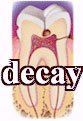 Dental Caries