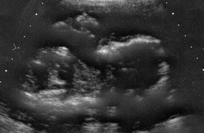 ultrasound