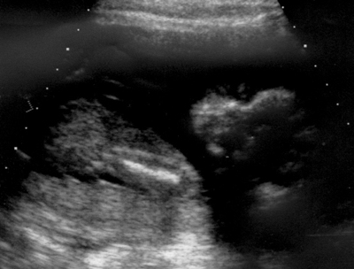 Ultrasound
