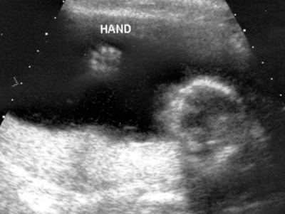 ultrasound