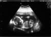 babywalker20weeks_small.jpg