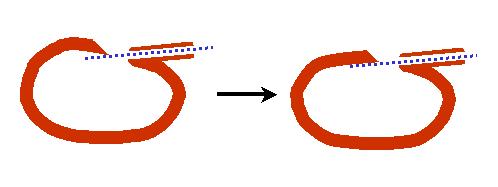 Drooping whistle opening syndrome