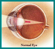picture of normal
		 eye